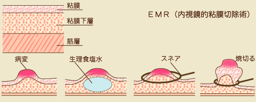 EMR（内視鏡的粘膜切除術）