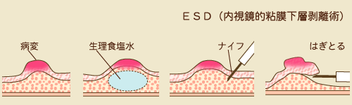 ESD（内視鏡的粘膜下層剥離術）